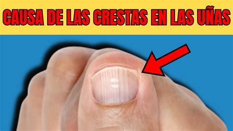 ¡CUIDADO! Por que se produce las CRESTAS VERTICALES en las UÑAS - YouTube