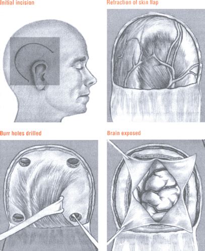 Craniotomy | Nurse Key