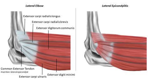 Lateral Epicondylitis Ultrasound