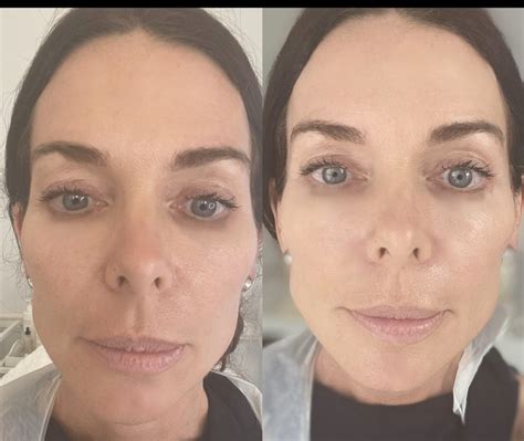 profhilo protocol specialist skin clinic nuriss