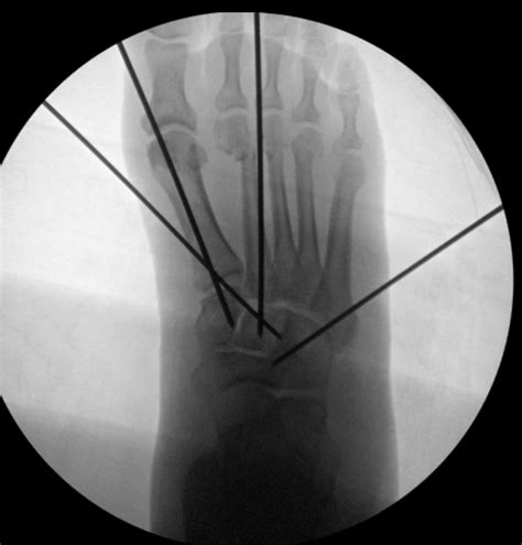 Lisfranc fracture - cmsmoli