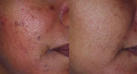 Best PIH post inflammatory hyperpigmentation treatments
