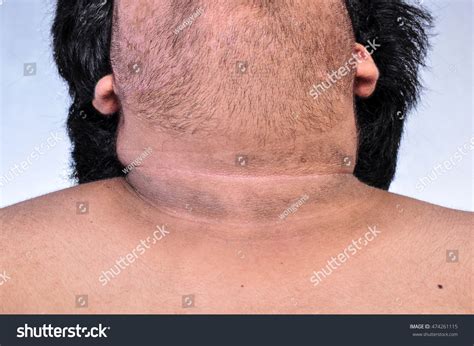 Dark Skin Around Neck Fat Man库存照片474261115 | Shutterstock