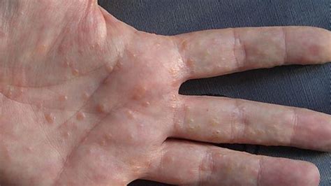 dyshidrotic eczema