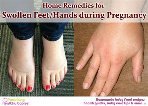 Swelling In Hands And Legs During Pregnancy - PregnancyWalls