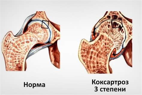 Коксартроз тазобедренного сустава: симптомы, причины, степени