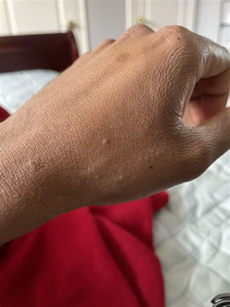 What are these tiny bumps around my left hand? : r/eczema