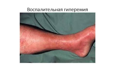 Артериальная гиперемия Причины и механизмы развития Признаки Работу