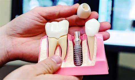 Можно ли провести имплантацию зубов бесплатно? | Стоматология Smile-at ...