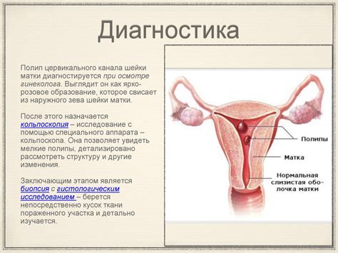Полипы шейки матки - презентация онлайн