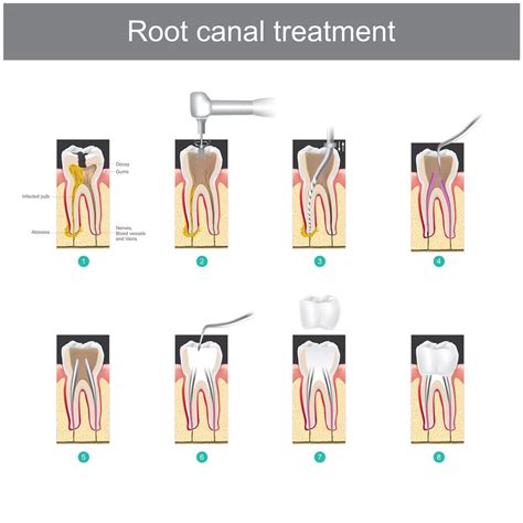 What is a Root Canal Therapy? | Mi DENTAL