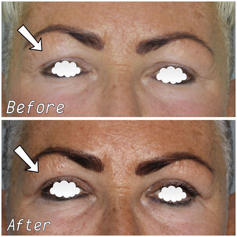 Blepharoplasty: eyelid surgery, price, before and after, cost UK, NHS