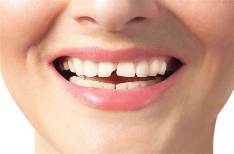 How to Fix a Chipped Tooth | Markham Dental Smiles