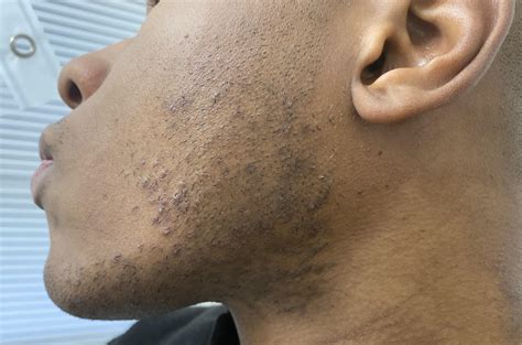 What is Hyperpigmentation and How Can You Cure It – Aaron Wallace