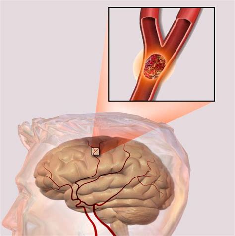 ictus  su rehabilitacion todo lo  necesitas saber fisiolution