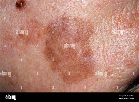 lentigo maligna   skin    year  female patient