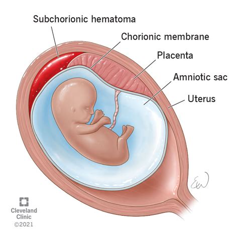 Subchorionic Hematoma: Causes, Symptoms & Treatment