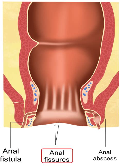 Anal Fissure, Abscess, and Fistula - Digestive and Liver Health Specialists