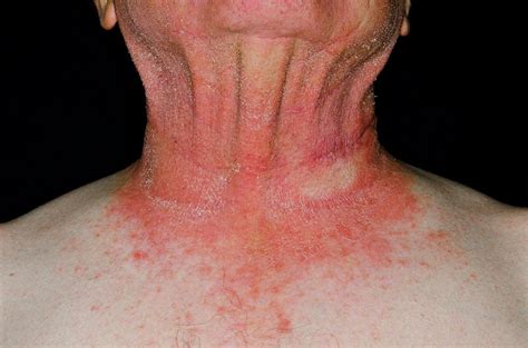 Photosensitive Rash On The Neck Photograph by Dr P. Marazzi/science ...