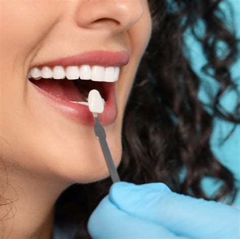 Зубные виниры - ERA ESTHETIC DENTAL