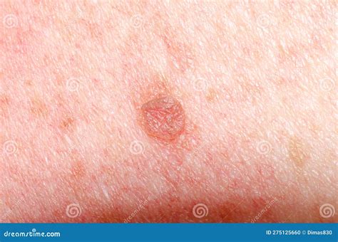 nevus  papilloma  mole  melanoma  keratosis   skin