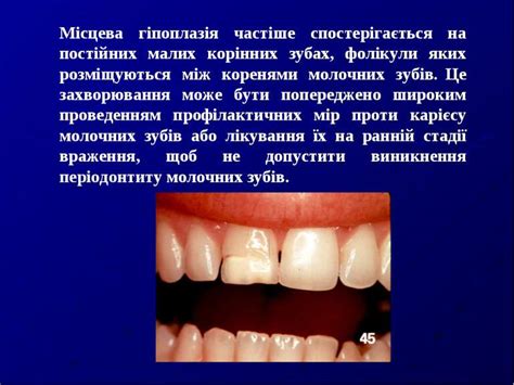 Гіпоплазія емалі: етіологія, патогенез, клініка, діагностика, лікування ...