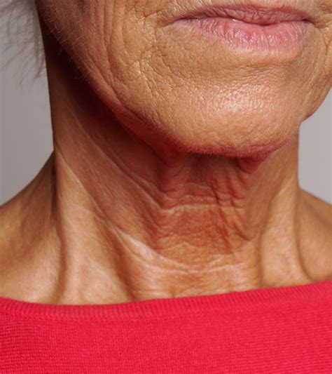How to Prevent Neck Wrinkles?