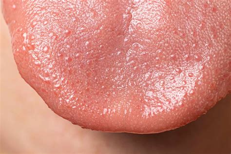 Bumps Under Tongue