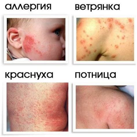 Виды сыпи с фото на спине