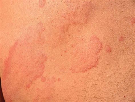 body itchy  hives  humberto watts blog