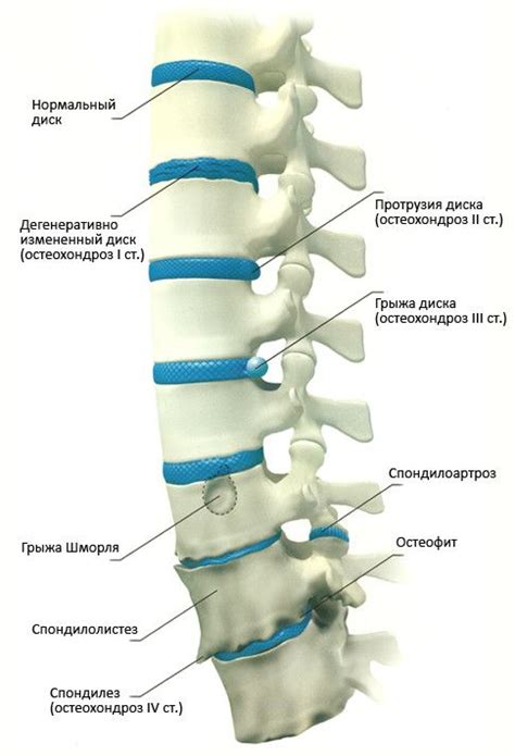 Остеохондроз | Медицина