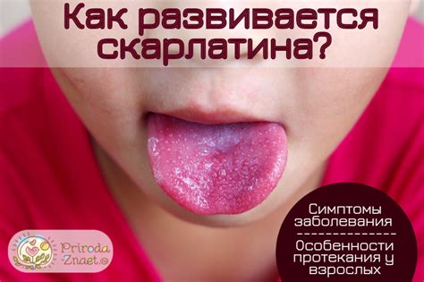 Скарлатина: симптомы и этапы развития