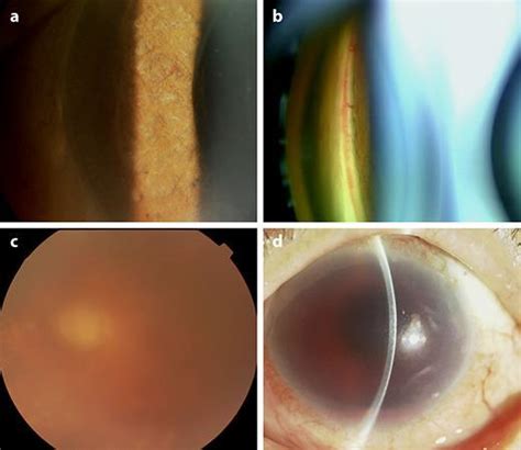 Neovascularization of the iris and angle recurred (a, b), and vitreous ...