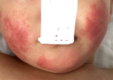 Lactose Intolerance Rash Definition & Facts For Lactose Intolerance