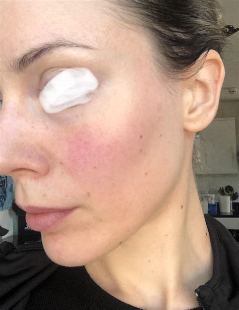 Facial Flushing Not Rosacea at Tristan Meehan blog
