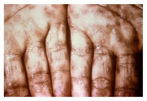 syphilis  learning mit lecturio