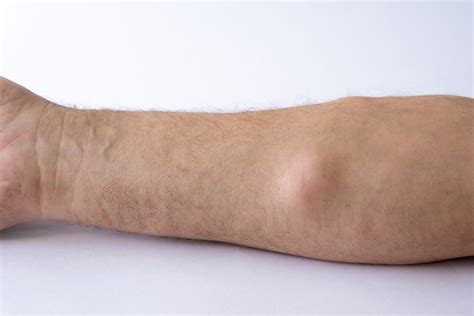 Lipomas vs. Liposarcoma - What’s the Difference?