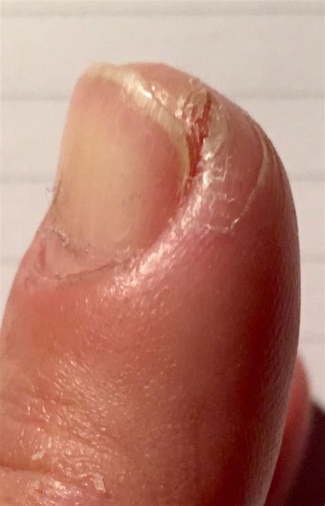 Severe dry cracked cuticles | Cracked cuticles, Cuticle, Dried