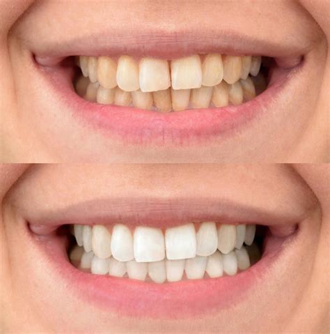 Teeth Whitening in Turkey at the TurDent Clinic