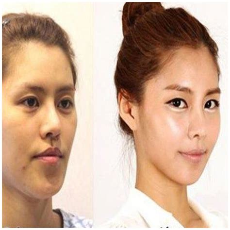 Chin Augmentation/Reduction » Partners in Plastic Surgery