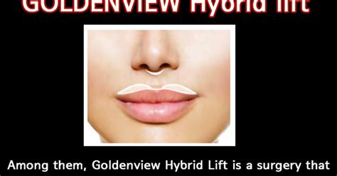 Goldenview Plastic surgery: Lip lift - philtrum surgery (philtrum ...