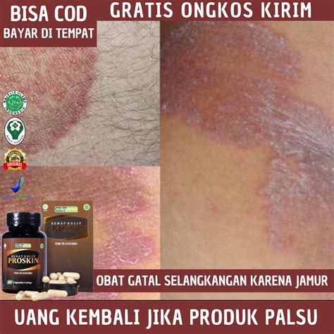 celah peha gatal  kering bersisik merah gatal ceasar bergstrom