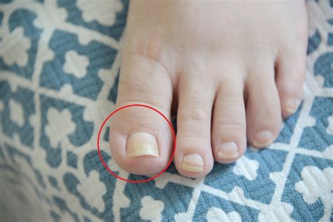 Cómo eliminar hongos en los pies | Salud180