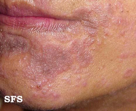 syphilis physical examination wikidoc