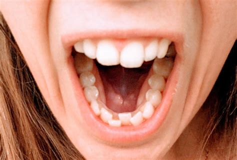 palate rorthotropics