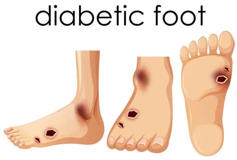 diabetes clipart vector images depositphotos