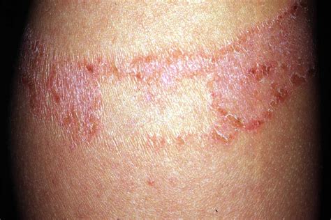 Contact Dermatitis: Symptoms, Rash, and Treatment