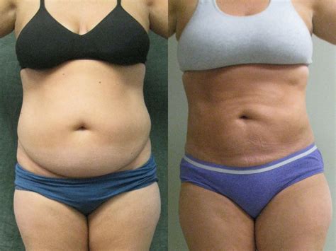 liposuction for menopause belly - Kory Yoo