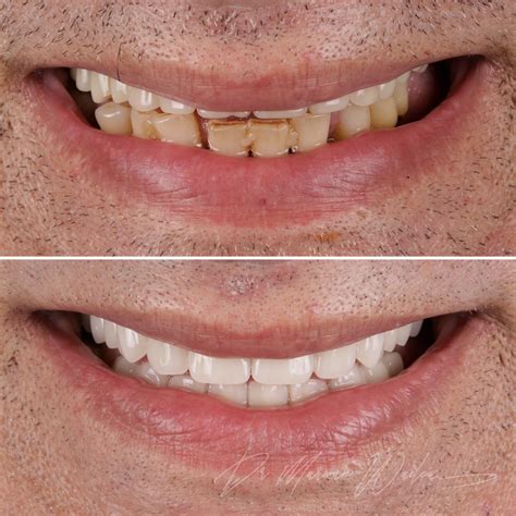 Digital Denture Solutions for Missing Teeth — Clean Teeth Dental