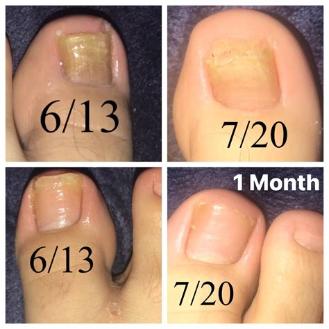 Pentachom Antifungal Laser System | Advanced Nail Fungus Treatment